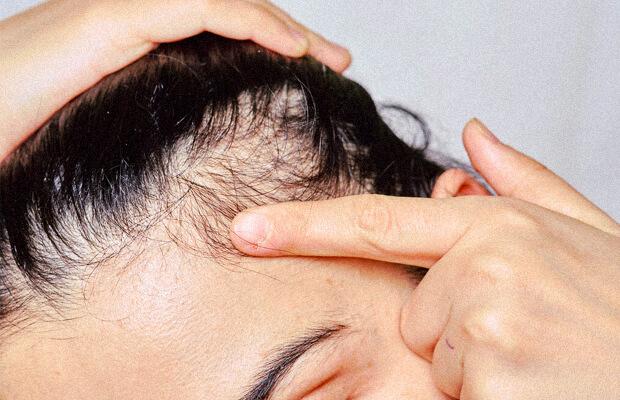 Are Your Hair Extensions Causing Itchy Scalp?